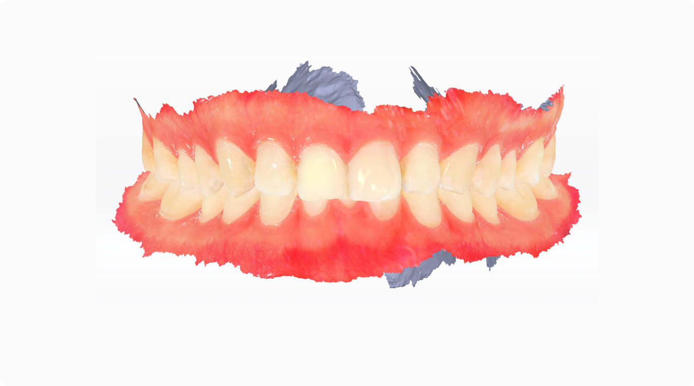 IOS for normal cases